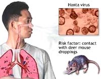 Lâm sàng, chẩn đoán bệnh do virus Hanta và những ca bệnh điển hình