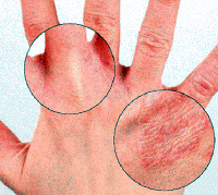 Chuyên mục giải đáp các bệnh chuyên ngành sốt rét, ký sinh trùng và côn trùng Tháng 01- 2013