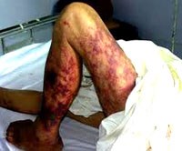 Mối hiểm họa từ tiết canh với hai căn bệnh truyền nhiễm nguy hiểm: viêm màng não do liên cầu lợn và ấu trùng sán lợn