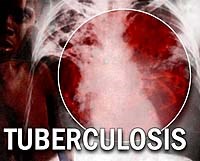  Hưởng ứng ngày thế giới phòng chống bênh Lao 24-3-2013