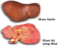 Không cho bệnh ung thư phát triển