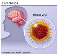 Thông tin quốc tế cập nhật: Viêm não do virus herpes ở người cần chẩn đoán phân biệt với bệnh lý não do ký sinh trùng 