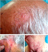 Viêm da gây ngứa và dị ứng do một loài ký sinh trùng nhỏ thuộc nhóm chân khớp Demodex spp lây truyền từ động vật sang người