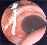 Nguy cơ mắc bệnh sán nhái từ món ăn đặc sản ếch, nhái, chim, rắn... 