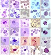 Thuốc phối hợp Artequick và Artequick cải tiến với hiệu lực cao điều trị ký sinh trùng sốt rét đa kháng thuốc tại các vùng sốt rét lưu hành