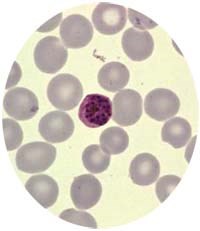 Sốt rét sơ nhiễm do Plasmodium falciparum dễ chuyển thành sốt rét ác tính gây tử vong