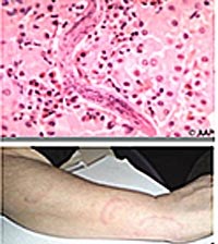 Một số điểm giống và khác nhau trong biểu hiện lâm sàng bệnh ấu trùng giun đũa chó/mèo ở người lớn và trẻ em