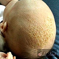 Điều trị “cứt trâu” trên da đầu trẻ sơ sinh