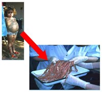 Thông tin cập nhật về các bệnh giun truyền qua đất của Tổ chức Y tế thế giới