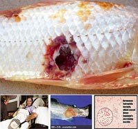 Vi khuẩn Aeromonas hydrophila có tiềm năng gây chết người đã xuất hiện tại Việt Nam