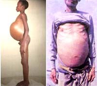 Việt Nam chưa có bệnh sán máng nhưng cần cảnh giác