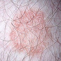 Nấm da (Dermatophytosis) và phòng chống bệnh nấm da