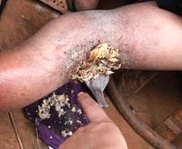 Các loại giòi ký sinh gây bệnh ở người