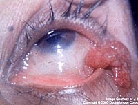 Đề phòng bệnh nấm ở mũi và mắt