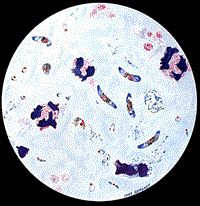 Cập nhật thông tin thế giới về sự đề kháng của ký sinh trùng với thuốc sốt rét và hợp chất mới kháng sốt rét có hiệu lực cao được phát hiện