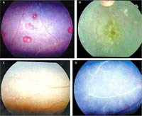 Thông tin cập nhật về suy thận cấp trong bệnh sốt rét (Phần 2)