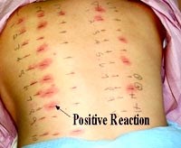 Dị ứng và những công cụ truy tìm tác nhân sinh bệnh (Phần 2)