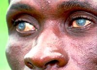 Cảnh giác bệnh mù lòa đường sông khi lao động tại châu Phi