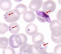 Plasmodium falciparum giảm nhậy thuốc phối hợp ACTs và hiện tượng kháng thuốc Artemisinin đầu tiên tại vùng sốt rét lưu hành không có giao lưu biên giới Cămpuchia