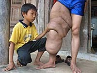 Phát hiện ấu trùng giun chỉ bạch huyết bằng xét nghiệm ban ngày