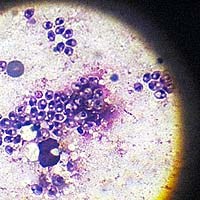 Tổ chức Y tế thế giới (WHO) chấp thuận 8 dự án để giải quyết các bệnh lãng quên 