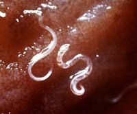 Rối loạn về máu và tuần hoàn do nhiễm giun móc