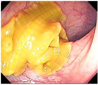 Sán dây Diphyllobothrium dendriticum-ký sinh trùng mới nổi ở người bị lãng quên