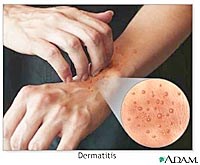 Viêm da trên tạng cơ địa dị ứng (Atopic Dermatitis): cần chẩn đoán phân biệt với nhiều bệnh do ký sinh trùng