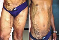 Bệnh sán máng trên toàn cầu: nguy cơ và thách thức