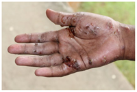 Hướng đến kiểm soát bệnh ghẻ ở người trên phạm vi toàn cầu: cần có sự hợp tác quốc tế