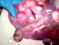 Chia sẻ lâm sàng & điều trị một số ca bệnh đặc biệt về sán lá gan lớn Fasciola gigantica 