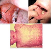 Tổ chức Y tế thế giới (WHO) cập nhật thông tin về bệnh sởi trên toàn cầu đầu năm 2014