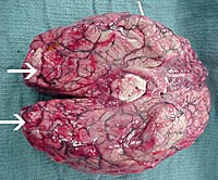 Viêm não màng não tiên phát và viêm não màng não dạng u hạt do ký sinh trùng Naegleria fowleri  và Acanthamoeba 