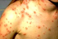 Bệnh thủy đậu có nguy cơ quay trở lại 