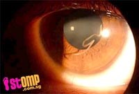 Giun chỉ Loa Loa sống ký sinh trong mắt người