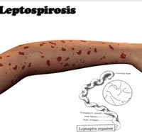 Leptospirose-một trong những căn bệnh nhiễm trùng cấp tính nguy hiểm truyền từ động vật sang người 