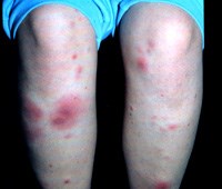 Thận trọng chẩn đoán hồng ban nút với thương tổn do ký sinh trùng ở người