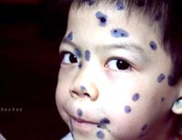 Điểm báo về các thông tin liên quan đến y tế ngày 7/3 năm 2014