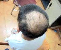 Rụng tóc, trọc đầu vì bệnh nấm tóc