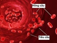 Theo dõi chỉ số tiểu cầu trong sốt xuất huyết