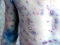 Dùng globulin miễn dịch đặc hiệu zoster điều trị bệnh thủy đậu