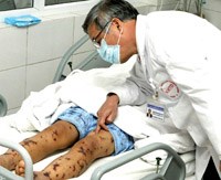 Chủ động ngăn chặn bệnh não mô cầu 