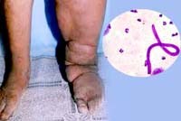 Thông tin cập nhật về phòng chống bệnh giun chỉ bạch huyết  của WHO