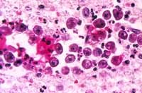 Cập nhật tài liệu nghiên cứu liên quan amip gây bệnh lý não và màng não trên thế giới (1960 – 2014)