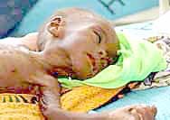 Suy dinh dưỡng trẻ em-hậu quả của đói nghèo và bất ổn chính trị