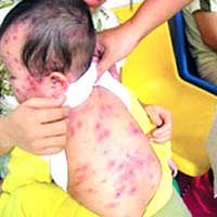 Diễn biến dịch bệnh sởi và chỉ đạo phòng chống sởi của Bộ Y tế