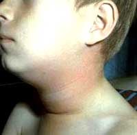 Vô sinh do teo tinh hoàn vì bệnh quai bị