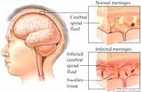 Bệnh Viêm não Nhật bản