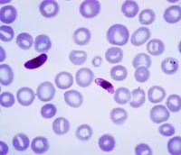 Thông tin cập nhật về biến chứng sốt rét thể não