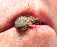 Chagas trong thế kỷ 21: Thành công trong lĩnh vực y tế công cộng hay bệnh truyền nhiễm đang nổi